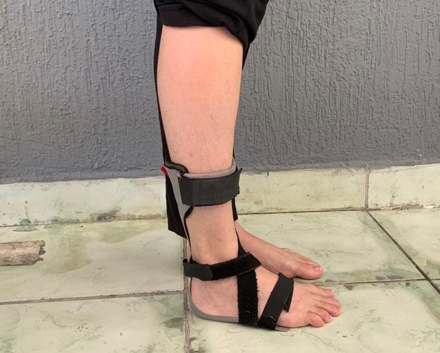 ÓRTESE ACESSÍVEL E PERSONALIZADA PARA PÉ E TORNOZELO É DESENVOLVIDA NA UFPB